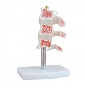 http://yuantech.de/246-292-thickbox/ya-l034-osteoporosis-model.jpg