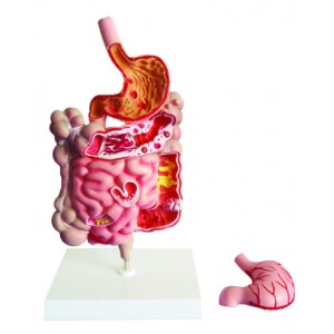 http://yuantech.de/301-616-thickbox/ya-d013-diseased-digestive-system-model.jpg
