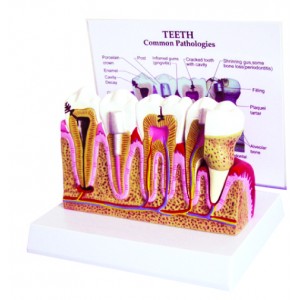 http://yuantech.de/329-635-thickbox/ya-d054-dental-pulp-disease-model.jpg