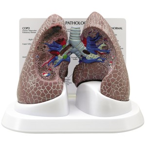 http://yuantech.de/341-397-thickbox/ya-r045-diseased-lung-model.jpg
