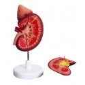 YA/U022 Enlarged Kidney with Adrenal Gland 2 Parts