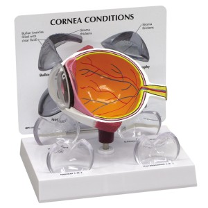 http://yuantech.de/442-724-thickbox/ya-s036-diseased-cornea-model.jpg