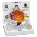 YA/S037 Cataract  Model