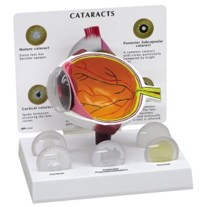 http://yuantech.de/443-725-thickbox/ya-s037-cataract-model.jpg