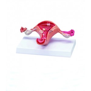 http://yuantech.de/565-836-thickbox/ya-p016-diseased-uterus-model.jpg