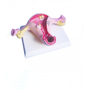 http://yuantech.de/566-837-thickbox/ya-p017-diseased-uterus-model.jpg